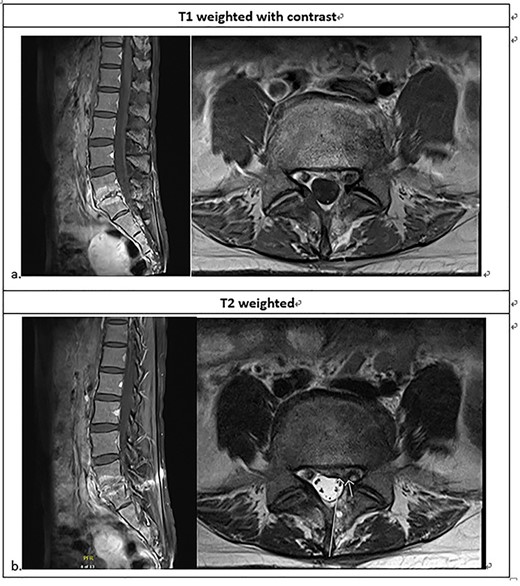 Lumbosacral MRI ~3 weeks after the intervention; less enhancement compared to the previous MRI at the L5-S1 intervertebral disc with adjacent endplates, consistent with spondylodiscitis; less compression of the left S1 nerve root.