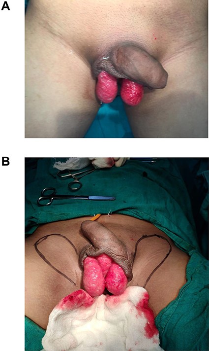 (A) Raw area showing bilateral testis; (B) markings of flaps to be raised.