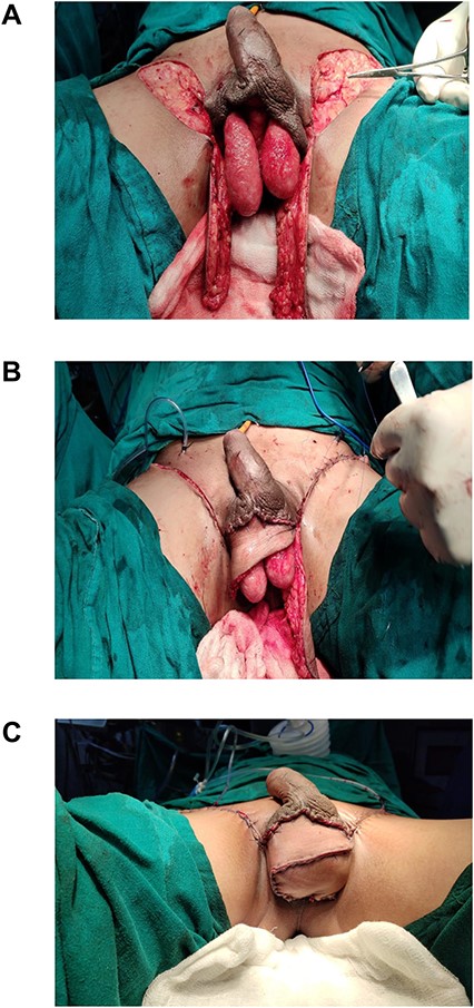 (A) Bilateral pudendal flaps raised; (B) closure of donor area and defect; (C) neo-scrotum.