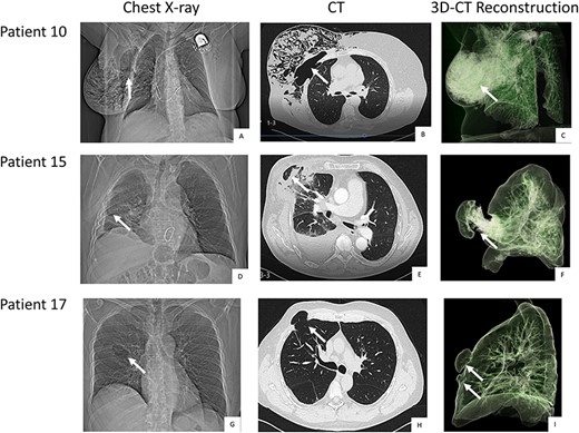 Pre-operative chest-X-ray, CT and thoracic CT reconstruction of patient 10 (A, B, C), 15 (D, E, F) and 17 (G, H, I). Legend: The white arrows point at the herniation. Patient 10 and 15 come with a single hernia. Patient 17 was diagnosed with double herniation.