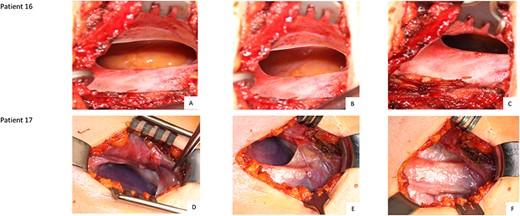 Intraoperative finding of patients 16 (A, B, C) and 17 (D, E, F): cavity of an extrathoracic epithelialized hernia Legend: Patient 16 has a single hernia. Patient 17 was diagnosed with double herniation.