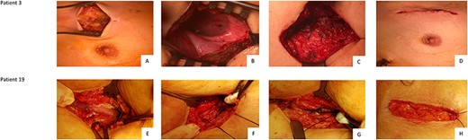 Chest wall reconstruction in Patient 3 (A, B, C, D) and Patient 19 (E, F, G, H) Legend: Patient 3: A: Opening of the skin. Hernia may be located substantially higher than the original skin incision; B: Display and opening of the epithelialized cavity. Preparation and excision; C: After thoracic drainage and 2–3 rib adapting sutures, the muscle is adapted; D: Closure of the subcutis followed by skin suture. Patient 19: E: Opening of the skin at the original incision. F: Placement of two rib adapting sutures after insertion of chest tubes. G: Continuous muscle adaption; H: Closure of the subcutis followed by skin suture.