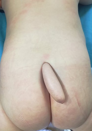 Clinic aspect of human tail.