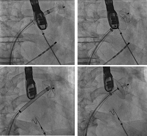 Cardiac catheterization: LAA occluder implantation; interventional LAA occluder implantation via the right femoral vein and septal puncture under radioscopy and transoesophageal echocardiography (TEE) control.