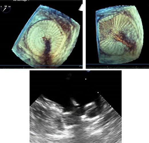 TEE for interventional LAA occluder implantation; TEE controlled, unsuccessful LAA occluder implantation due to difficult LAA morphology.
