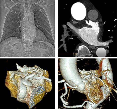 Preoperative cardiac computed tomography (CT) ‘Chicken wing’ morphology of the LAA; cardio CT for presentation of the special (Chicken wing morphology) of the LAA and for exclusion of coronary heart disease before surgical LAA clip implantation.