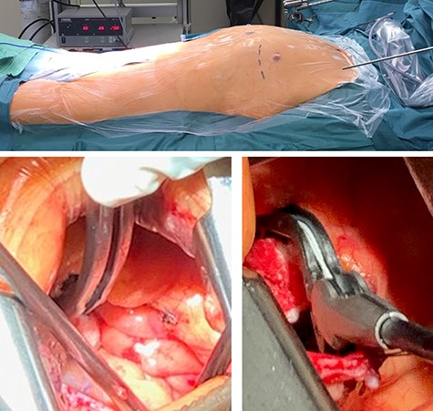 Intraoperative photographs: set-up and LAA clip; intraoperative setup and intra-thoracic images of the LAA clip positioning/implantation.
