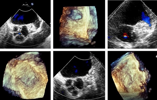 Transoesophageal echocardiography control of the LAA clip in correct position at the LAA base with display of the complete LAA closure.