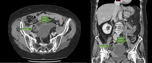 Axial and coronal CT-scan showing the dilated appendix in close proximity to the cystic lesion.