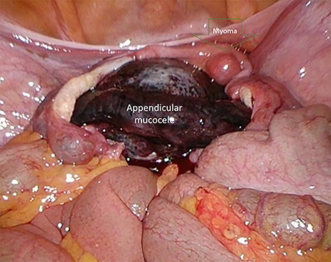 Pre-operative image of a small uterus myoma and the appendicular tumor with ischemic discoloration due to the torsion.