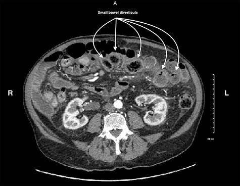 CT scan of the abdomen and pelvis showing small bowel diverticula with inflammation and stranding consistent with uncomplicated diverticulitis.