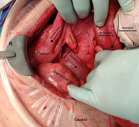 Intraoperative photograph demonstrating: (i) the duodenojejunal flexure entering the intraabdominal space deep to the ileocecal mesentery, on the right side of the abdomen (ii) volvulus of the jejunum around its mesentery (iii) terminal ileum coursing superior to the volvulized jejunum.