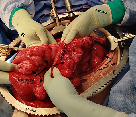 Intraoperative photograph demonstrating extensive small bowel diverticulosis with dilatation of the small bowel secondary to obstruction from midgut volvulus – also visible are segments of normal small bowel.