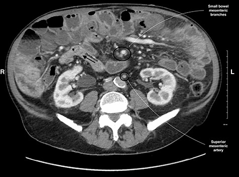 CT image of the right sided position of duodenojejunal flexure, entering the intraperitoneal cavity on the right side of the abdomen.