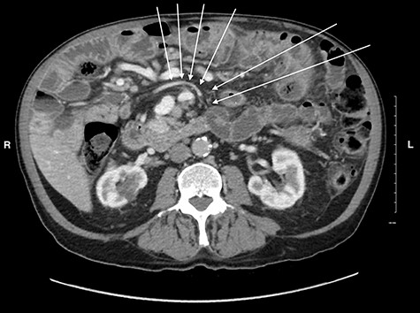 CT image showing a subtle swirl of the mesenteric vein, coursing from the left to the right side of the abdomen indicating volvulus of the small bowel.