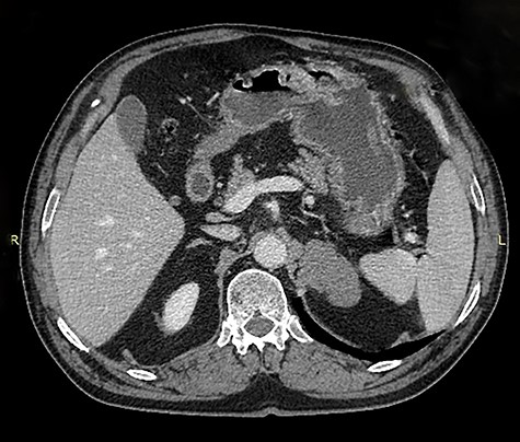 Axial image of contrast enhanced computed tomography of abdomen showing a mass that was thought to be arising from the left adrenal gland.