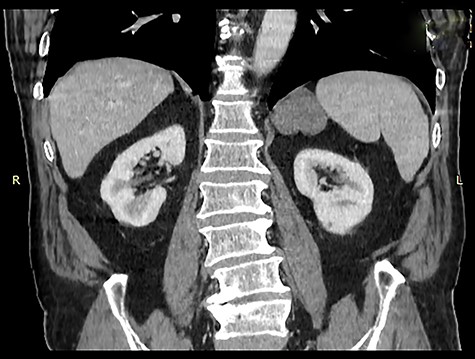 Coronal image of contrast enhanced computed tomography of abdomen and pelvis showing a hypodense mass in the region of the left adrenal gland, medial to the spleen and above the kidney.
