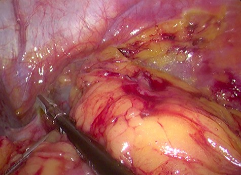 Laparoscopic view of the retroperitoneal space containing the left adrenal gland and a cystic lesion surrounded by large amounts of adipose tissue.