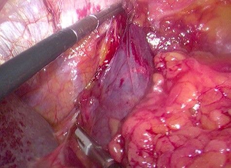 Laparoscopic en bloc resection of the retroperitoneal cystic lesion adherent to the left adrenal gland and adipose tissue.