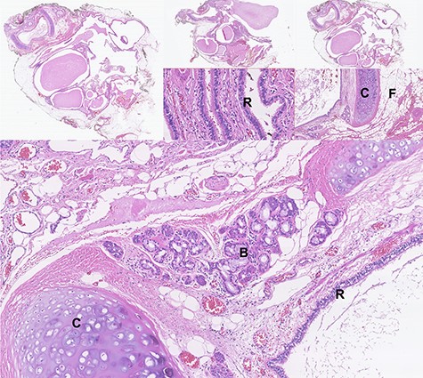 Photomicrographs of haematoxylin-eosin stained tissue sections showing the microscopic features of the mature cystic teratoma: cystic spaces lined with respiratory epithelium (R), areas of cartilage (C) with mucinous- and serous-type bronchial glands (B), abundant fibroadipose tissue (F), lymphoid structures, smooth muscle, nerve and ganglionic tissue.