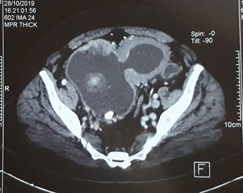 CT-scan of the bladder 2 months before the rupture showing bladder tumor in the dome and in intradiverticular and a bladder stone.