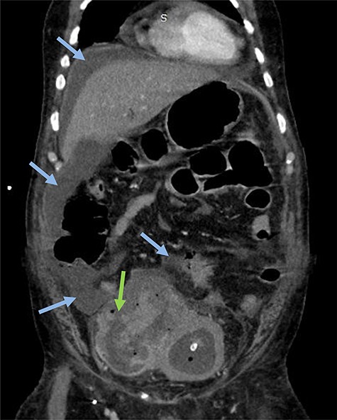 Emergency CT-scan showing intraperitoneal swallowing (blue arrows) due to a fistulization of the bladder (green arrow).