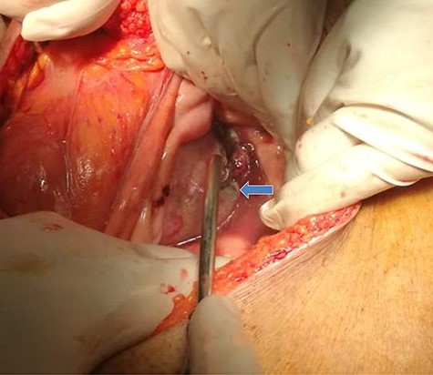 Intraoperative findings included a 2 cm defect at a bladder diverticulum (intraperitoneal view).