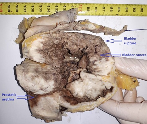 Macroscopic appearance of rupture in a tumor bladder.