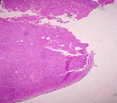 H & E staining viewed under x10 with Olympus CX23 showing bladder wall infiltration with a SCC perforating serosa (bladder surface inked).