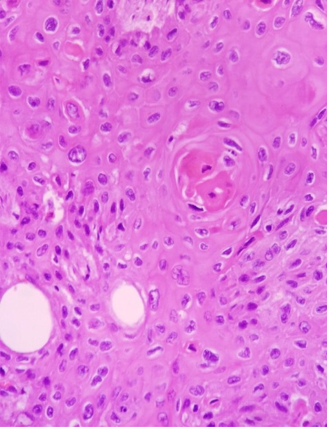 H & E staining viewed under x40 with Olympus CX23 showing a well differentiated SCC (Presence of keratin pearls and intercellular bridges).