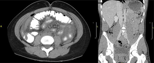 (a) CT abdomen and pelvis axial view. (b) CT abdomen and pelvis coronal view: there is a large pneumoperitoneum predominantly in the upper abdomen.