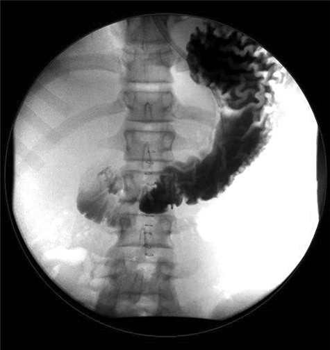 Upper gastrointestinal series (a)/small bowel follow-through (b): normal stomach demonstrated. Normal duodenum and proximal jejunal loops. No contrast extravasation identified. Oral contrast in the distribution of stomach, duodenum and proximal jejunal loops with no evidence for extravasation.