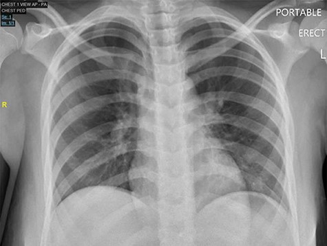 Chest X-ray PA, showing no cardiopulmonary disease, or free air under diaphragm.