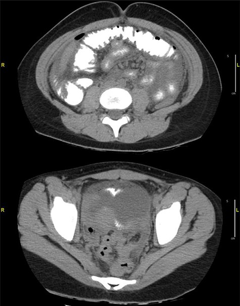 Diffuse infiltration of the mesentery is seen. A component of bowel wall thickening is seen in the distal ileum and the transverse colon. In the pelvis, a focus of extraluminal air is seen on the right. Free mesenteric fluid is seen as well.