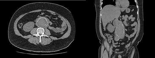 CT-KUB showing a large fusiform infra-renal AAA with moderate to severe retroperitoneal stranding (white arrow).