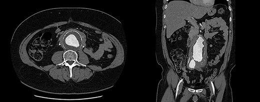 CTA demonstrating (A) a large 61mm × 63mm infrarenal AAA and (B) bilateral common iliac aneurysms (right 41mm × 44mm, left 31mm × 36mm).