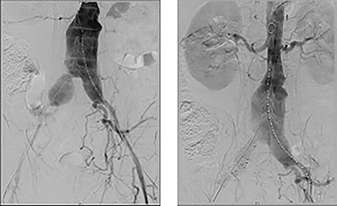 On table completion angiogram demonstrating good flow through the stent graft and satisfactory flow through renal arteries and iliac branching device with no endoleak.