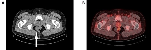 A: Axial slice of the CT pelvis demonstrating a cystic structure in the right presacral space adjacent to the rectum (white arrow). B: FDG-PET/CT reconstruction imaging demonstrating the same cystic lesion adjacent to the FDG-avid rectum. The medial end of the cyst demonstrates FDG-avidity, though it is unclear whether this is intrinsic or artefact from the neighbouring rectum.