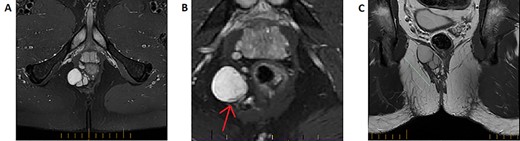 T2-weighted MRI imaging. A: Axial slice taken below the perineal floor demonstrating a multilobulated T2-hyperintense lesion suggestive of a predominantly cystic structure. B: A zoomed slice on the same sequence taken cephalad to (A) indicates that the structure is inhomogeneous—a rim of T2-hypointensity exists at its medial end (red arrow). This represents a solid component and would raise suspicion for malignant potential. C: Coronal slice of the T2 fat-suppression sequence MRI highlighting the cranio-caudal extension of the lobulated structure.