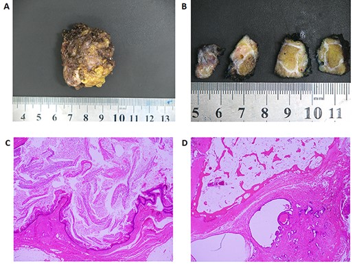 Histology. A: Photo of the macroscopic specimen resected en-bloc. B: Serial sectioning of the specimen shows a cystic structure that is heterogeneous in its composition. C: H&E staining of a section of the cyst containing squamous epithelium and abundant keratin (×20 magnification). D: H&E staining of the coccyx with evidence of prostate glandular tissue adjacent to bone. Immunohistochemistry later showed this tissue to be PSA, PSMA, androgen receptor and NKX3.1 positive confirming the presence of mature prostatic tissue.