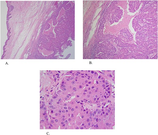 (A and B) ×4 and ×20 magnification hematoxylin and eosin (H&E) stain demonstrating areas of mixed solid and trabecular areas. (C) ×60 magnification H&E stain demonstrating areas with large nuclei and many prominent mitotic figures.
