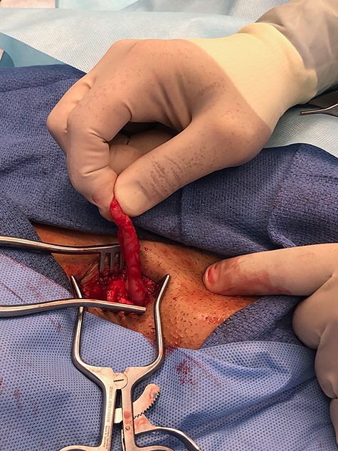 Lightly grasping the dissected appendix, freed from the femoral hernia sac in which it was incarcerated.