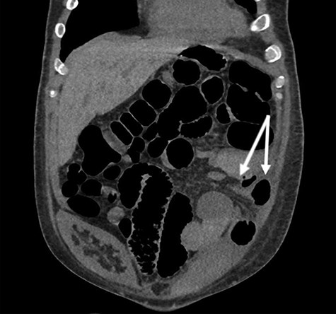 Coronal view of non-contrast CT with arrows denoting herniated mesentery and small bowel into the retroperitoneum. Note the nonfunctional prior renal transplant in the right hemipelvis.