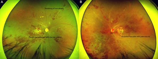 Hemorrhagic occlusive vasculitis in Behçet’s Disease. Wide angle fundus photos (Optos, Marlborough, MA) of the right (A) and left eye (B) demonstrating innumerable intraretinal hemorrhages concentrated in the macula and midperiphery, multiple sclerotic vessels and retinal soft exudates indicative ischemia, more prominent in the left than right eye.