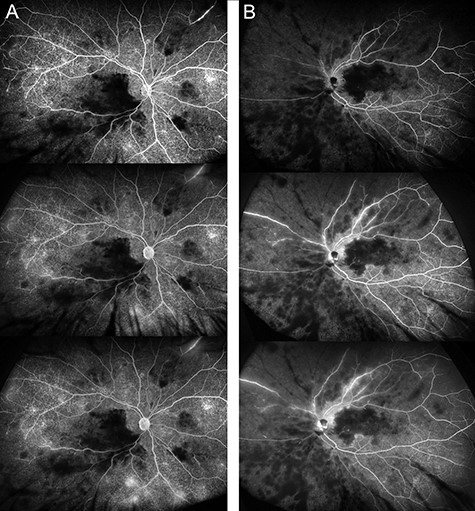 Severe retinal nonperfusion and infarction in Behçet’s Disease. Fluorescein angiography (FA) of right (A) and left eye (B) from early to late phase demonstrating areas consistent with severe retinal capillary nonperfusion and retinal infarction with persistent vasculitis more prominent in the left than right eye. Severe macular ischemia with enlarged FAZ secondary to occlusive vasculitis, a hallmark of Behcet’s disease.