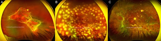 Pre- and postoperative fundus photos of combined rhegmatogenous retinal detachment (RRD) and tractonal retinal detachment (TRD) with proliferative vitreoretinopathy in Behçet’s Disease. (A) Combined funnel RRD and TRD in the left eye. (B) Postpars plana vitrectomy, membrane peel and endolaser in the left eye with flat retina with laser scars one month after surgery. (C) Flat retina with laser scars 1 year after surgery; VA was 20/400.