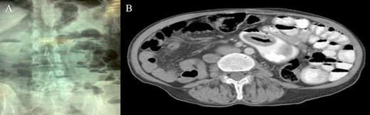 (A) Upright plain X-ray; (B) CT scan: sac-like lesion with macro-calcifications.