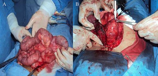 (A) Diffuse JD; (B) proximal large and hard jejunal diverticulum.