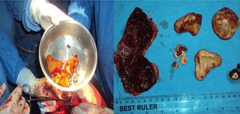 Stones with different sizes extracted from the resected diverticulum.