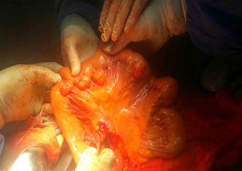 Incidental finding of jejunal diverticulosis during Whipple’s procedure.